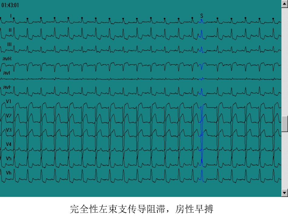 完全性左束支传导阻滞，SVE[共1页]_第1页