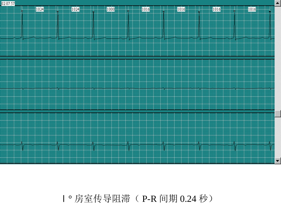 Ⅰ度房室传导阻滞_第1页