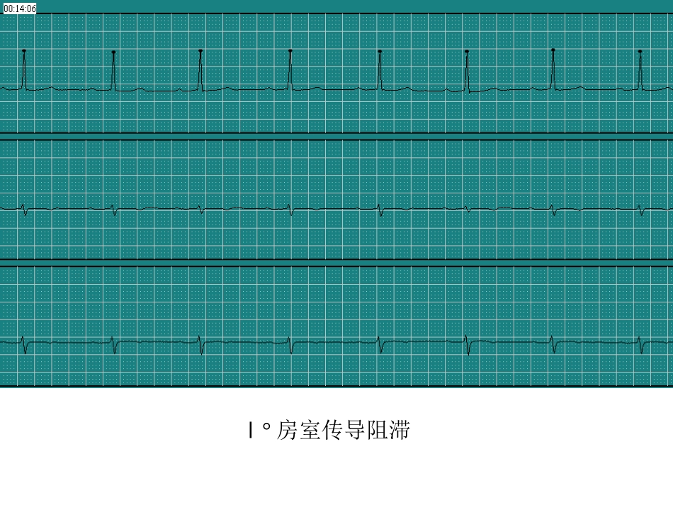 房室传导阻滞[共1页]_第1页