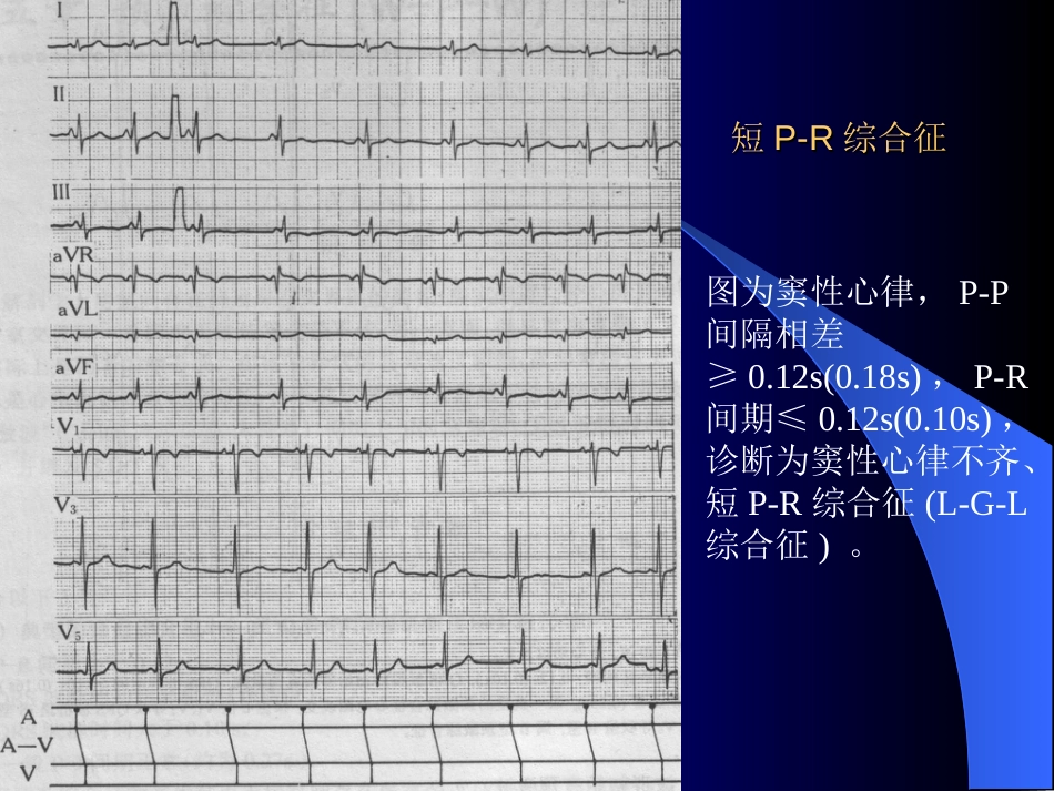 短PR综合征[共1页]_第1页