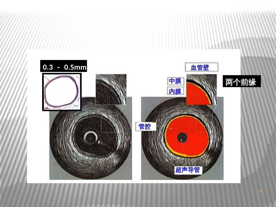 BasicsofIVUSimageinterpretation-介入血管内超声_第2页