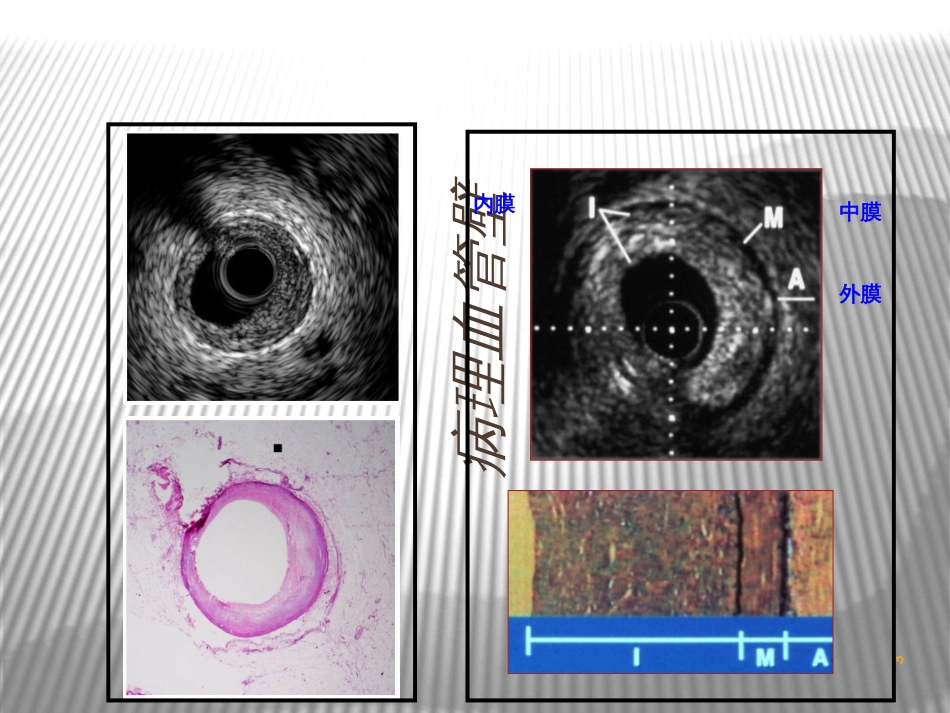 BasicsofIVUSimageinterpretation-介入血管内超声_第3页
