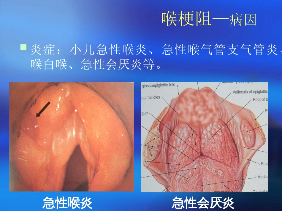 喉梗阻课件[共52页]_第3页