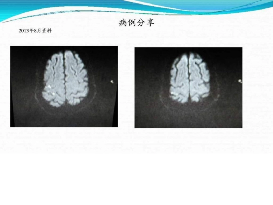 Trousseau综合征临床医学医药卫生专业资料.ppt文档资料_第2页