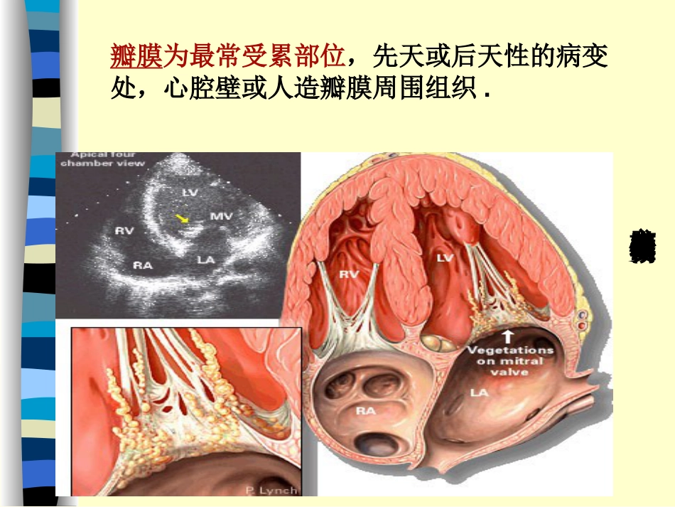 7第七节感染性心内膜炎病人护理[共37页]_第3页