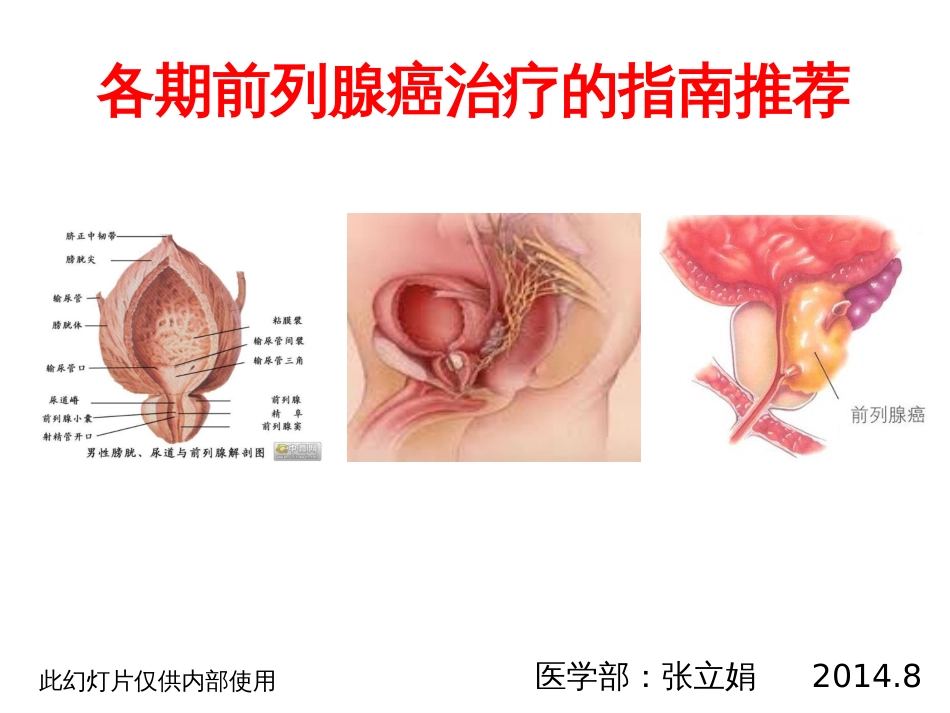 各期前列腺癌治疗的指南推荐[共44页]_第1页