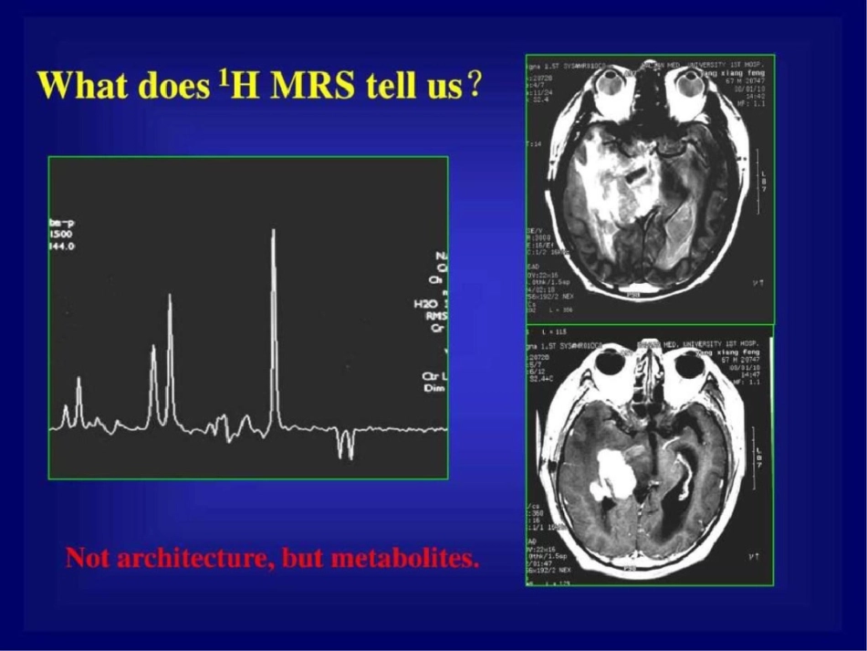 磁共振氢质子波谱在颅脑疾病诊断的临床应用.ppt文档资料_第2页