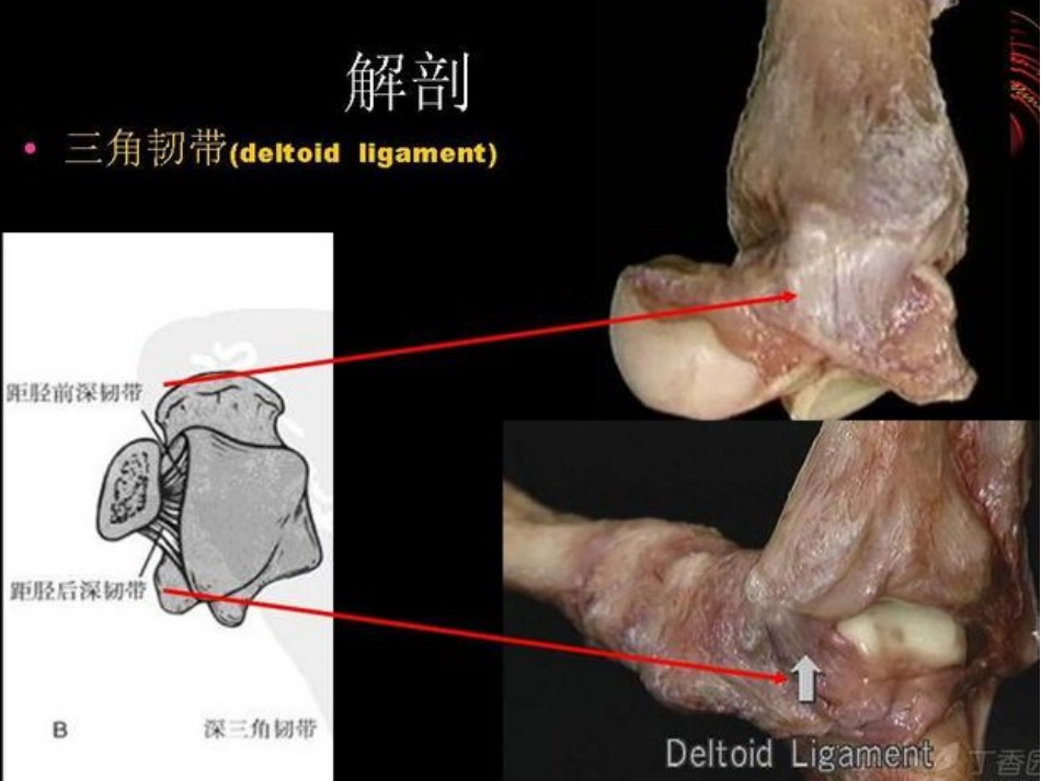 踝关节骨折Laugehansen分型的理解与评价_第3页