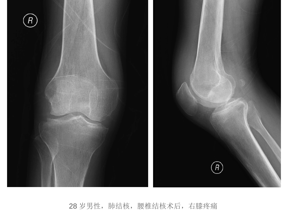 膝关节结核的影像学诊断_第2页