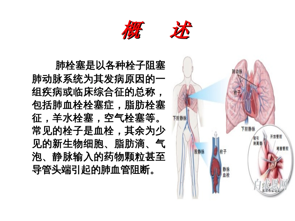 肺栓塞护理查房[共40页]_第2页