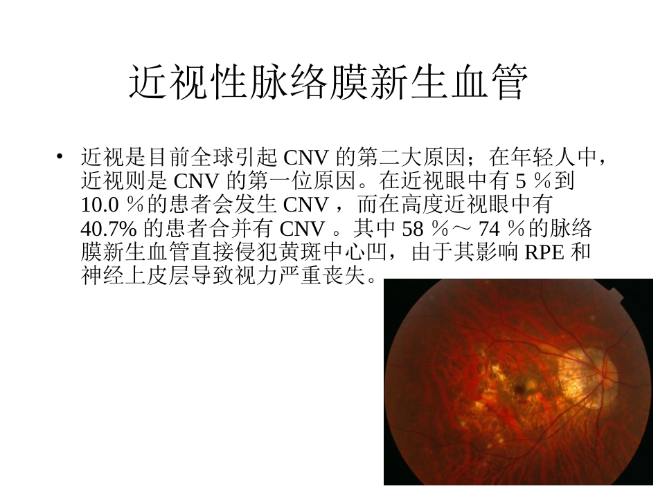 高度近视黄斑新生血管改[共22页]_第1页